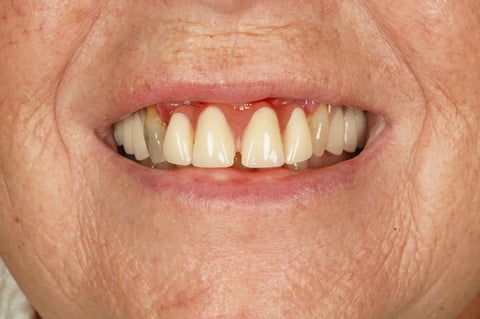 Before patient-designed replacement denture — example case