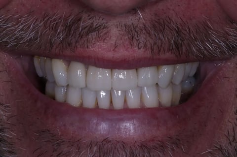 After straightened, brightened & refined — invisalign with 4 emax veneers — example case