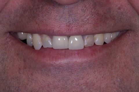 Before brighter & balanced — whitening with emax crowns & veneers — example case