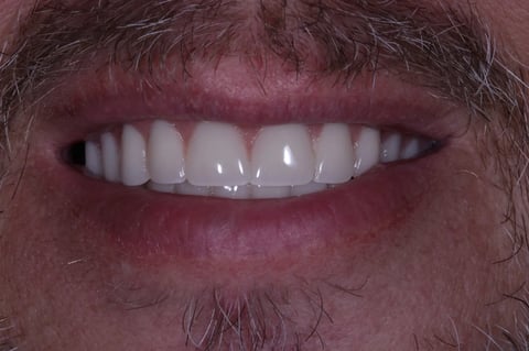 After a full reset — clearance with immediate & final upper denture — example case