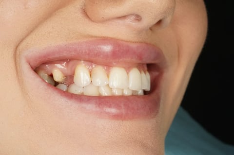 Before closing a long-standing gap with a two-unit bridge — example case
