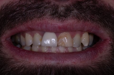 Before replacing a dark crown & restoring a chipped front tooth — example case