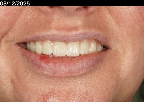 After a first smile in years — upper acrylic denture — example case