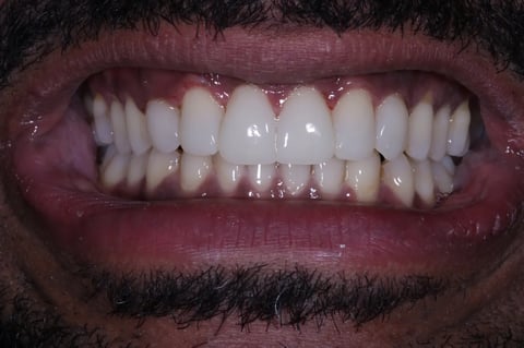 After invisalign, whitening & bonding — reshaped retained baby teeth — example case
