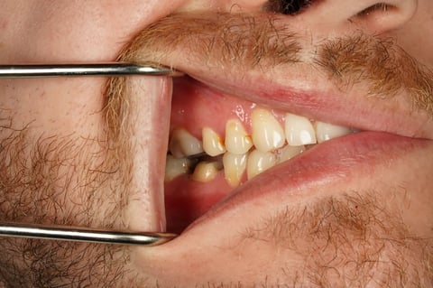 Before saved & protected — molar root canal with zirconia crown — example case