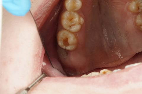Before sensitive to bite — small cavity, composite restoration — example case