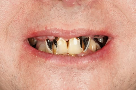 Before full mouth clearance & immediate dentures — example case