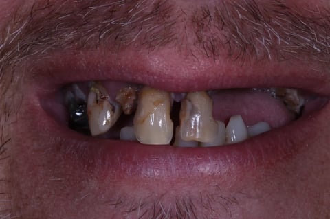 Before a full reset — clearance with immediate & final upper denture — example case