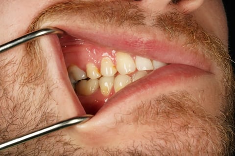 After saved & protected — molar root canal with zirconia crown — example case