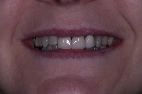 Before digital smile design — 6 layered zirconia crowns — example case