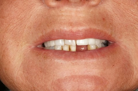 Before "nothing could be done" — small lower denture, big difference — example case