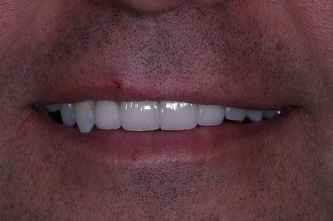 After brighter & balanced — whitening with emax crowns & veneers — example case