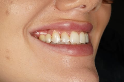 After closing a long-standing gap with a two-unit bridge — example case