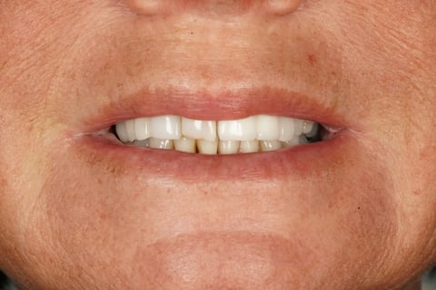 After "nothing could be done" — small lower denture, big difference — example case
