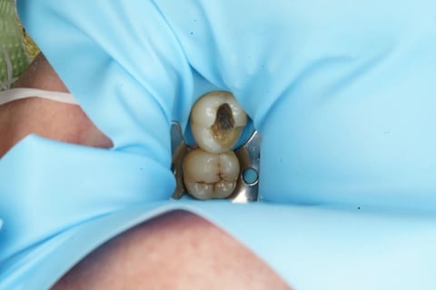 Before saving a tooth others said couldn't be saved — emax onlay — example case