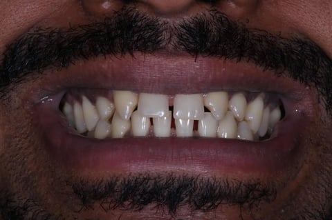 Before invisalign, whitening & bonding — reshaped retained baby teeth — example case