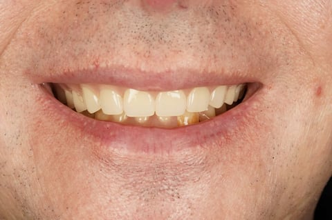 After full mouth clearance & immediate dentures — example case