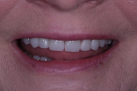 After severe wear restored — 8 zirconia crowns — example case