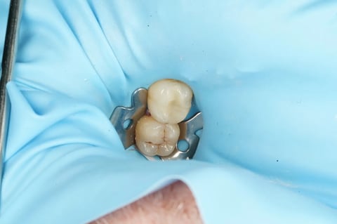 After saving a tooth others said couldn't be saved — emax onlay — example case