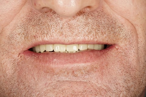 After full mouth reset — upper & lower dentures after clearance — example case
