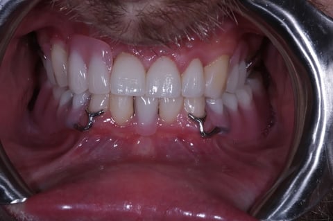 After full smile rehabilitation — crowns, bonding & cobalt chrome dentures — example case