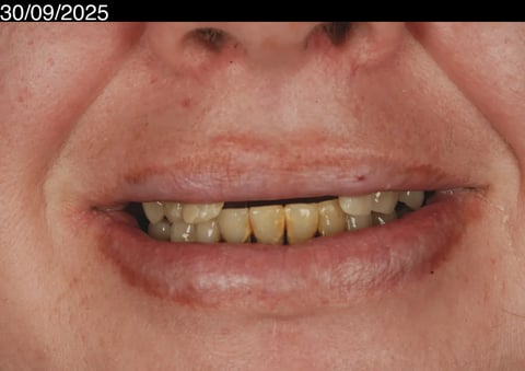 Before a fresh start — upper clearance with lower hygiene — example case