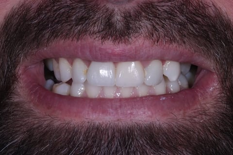 After replacing a dark crown & restoring a chipped front tooth — example case