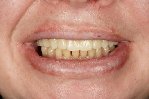 After a fresh start — upper clearance with lower hygiene — example case