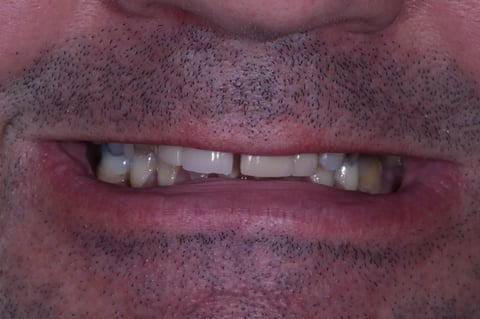 Before refreshed & rebuilt — whitening with 6 emax crowns — example case