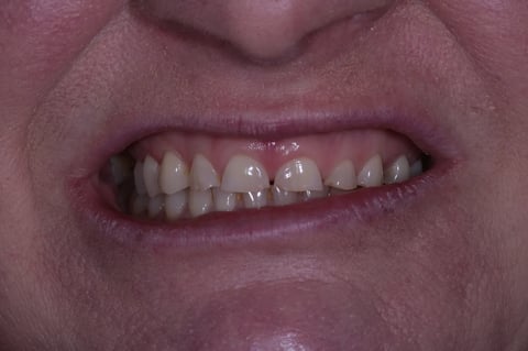 Before severe wear restored — 8 zirconia crowns — example case