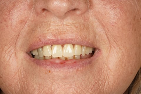 After patient-designed replacement denture — example case
