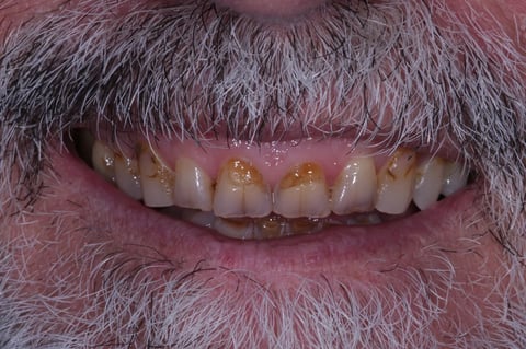 Before rebuilt & refreshed — composite bonding on 6 front teeth — example case
