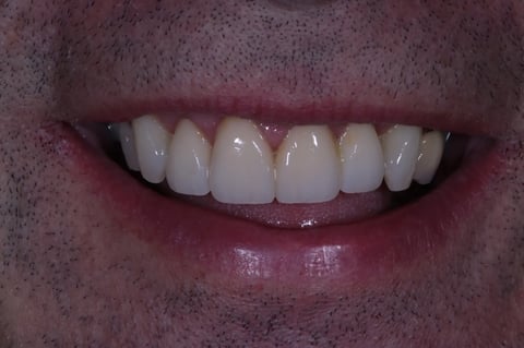 After rebuilt front teeth — whitening with zirconia crowns & bridge — example case