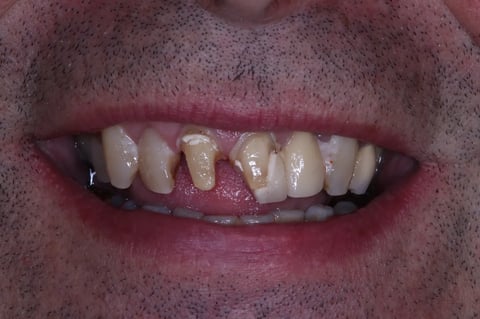 Before rebuilt front teeth — whitening with zirconia crowns & bridge — example case