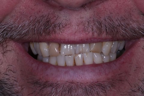 Before straightened, brightened & refined — invisalign with 4 emax veneers — example case