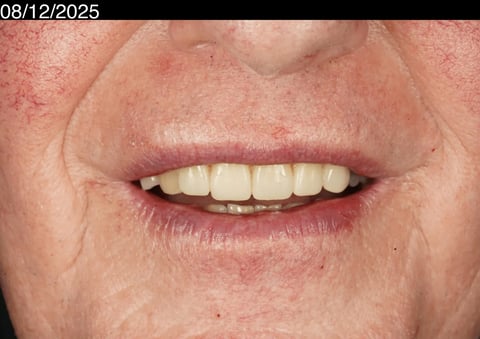 After a more secure smile — cobalt chrome denture — example case