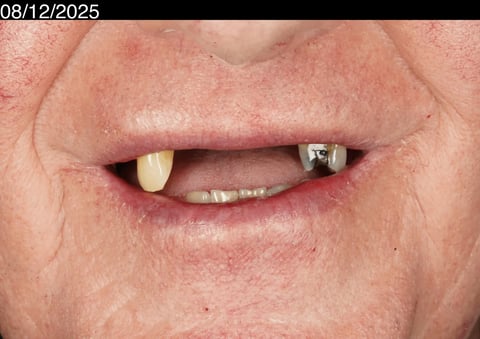 Before a more secure smile — cobalt chrome denture — example case