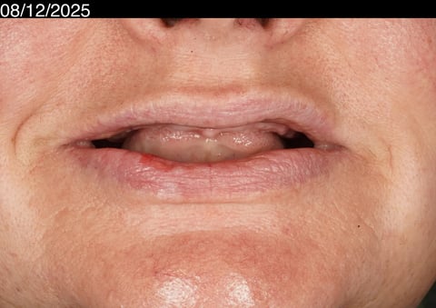 Before a first smile in years — upper acrylic denture — example case