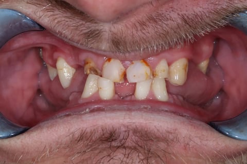 Before full smile rehabilitation — crowns, bonding & cobalt chrome dentures — example case