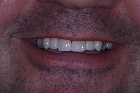 After refreshed & rebuilt — whitening with 6 emax crowns — example case