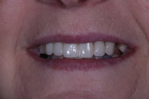 After digital smile design — 6 layered zirconia crowns — example case