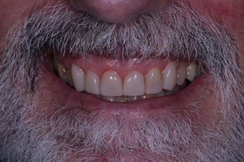 After rebuilt & refreshed — composite bonding on 6 front teeth — example case