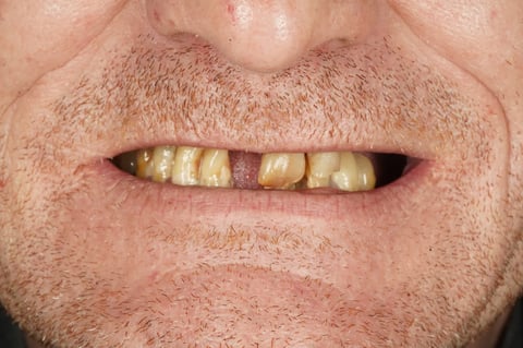 Before full mouth reset — upper & lower dentures after clearance — example case