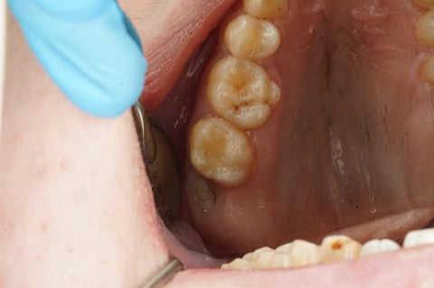After sensitive to bite — small cavity, composite restoration — example case